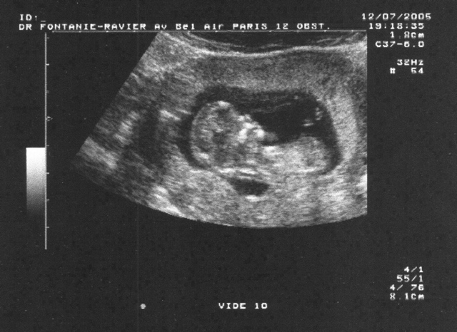 12-week scan
