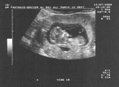 12-week scan